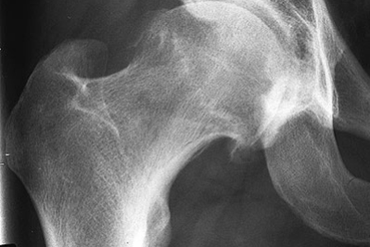 Abb. 2: Röntgenbild der rechten Hüfte eines 28-jährigen Mannes vor der Operation mit reaktiven, krankhaften Knochenanbauten am Übergang vom Schenkelhals zum Hüftkopf.